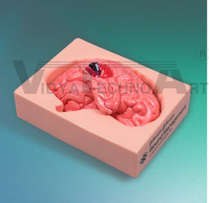 Brain Tumor Surgery Model